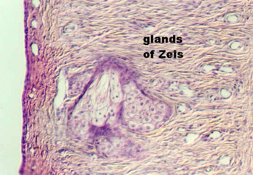 eyelid4.jpg (99399 bytes)