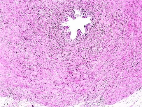 vas_deferens4.jpg (212796 bytes)